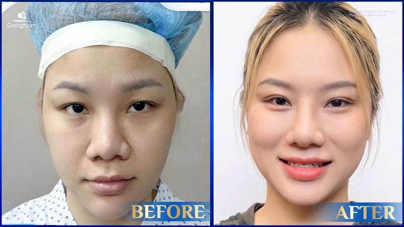 Cắt mí ở đâu đẹp? Mách bạn địa chỉ cắt mí an toàn - uy tín 8 Cắt mí ở đâu đẹp?