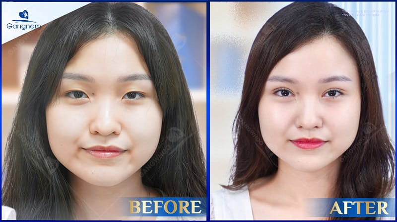 Cắt mí ở đâu đẹp? Mách bạn địa chỉ cắt mí an toàn - uy tín 7 Cắt mí ở đâu đẹp?