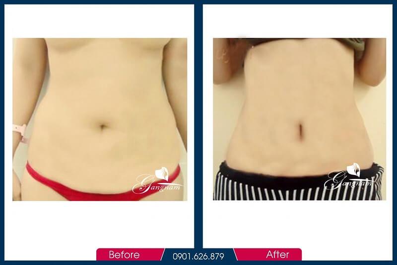 Hình ảnh trước và sau khi đánh tan mỡ bụng bằng Lipo Mìnat