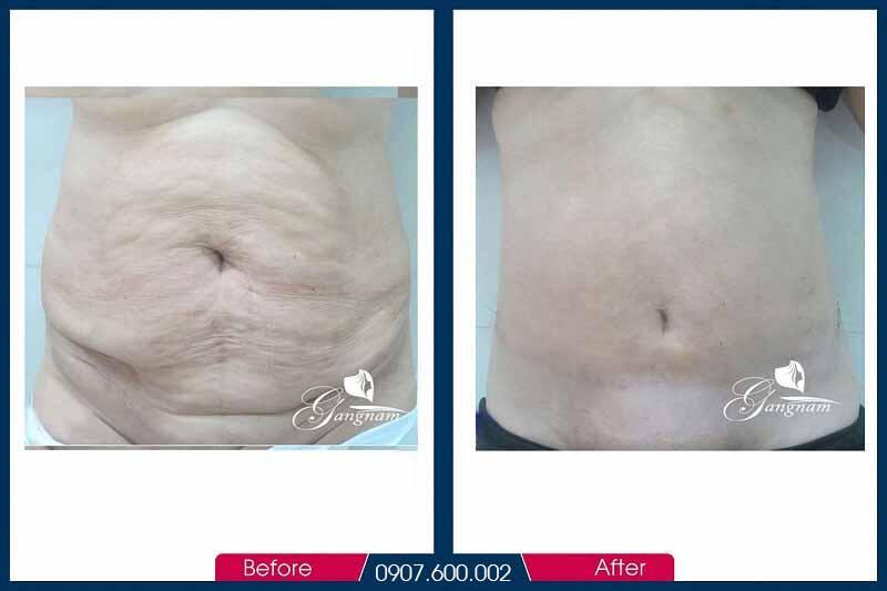 Công Nghệ Tan Mỡ Lipo Minfat 19 Công nghệ tan mỡ Lipo Minfat