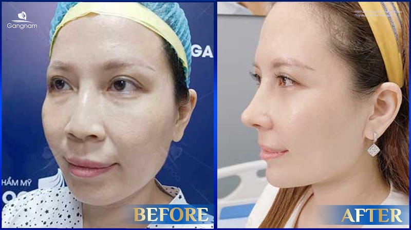 Độn cằm V-Line là gì? Có vĩnh viễn không? 9 Độn cằm V-line
