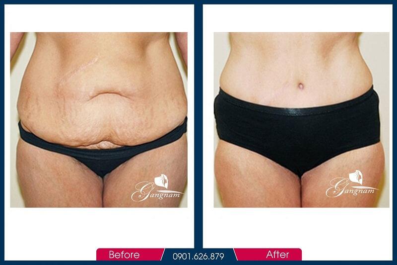 Hình ảnh trước và sau khi giảm mỡ bụng mini