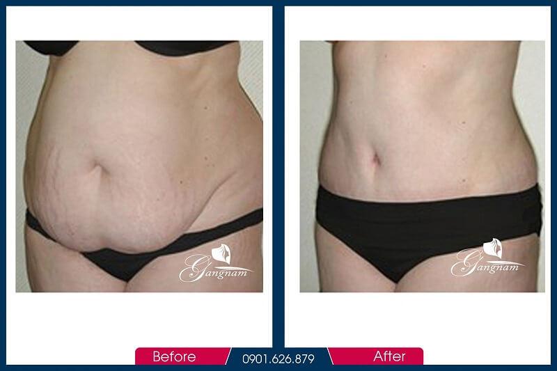 Hình ảnh trước và sau khi giảm mỡ bụng mini
