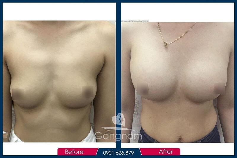 Hình ảnh khách hàng trước và sau khi nâng ngực nôi soi tại Thẩm Mỹ Viện Gangnam