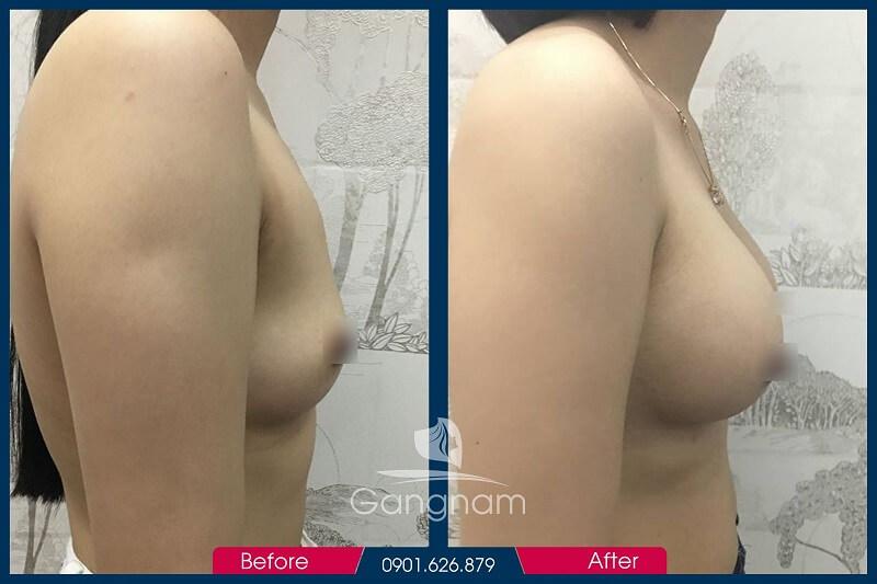 Hình ảnh khách hàng trước và sau khi nâng ngực nôi soi tại Thẩm Mỹ Viện Gangnam