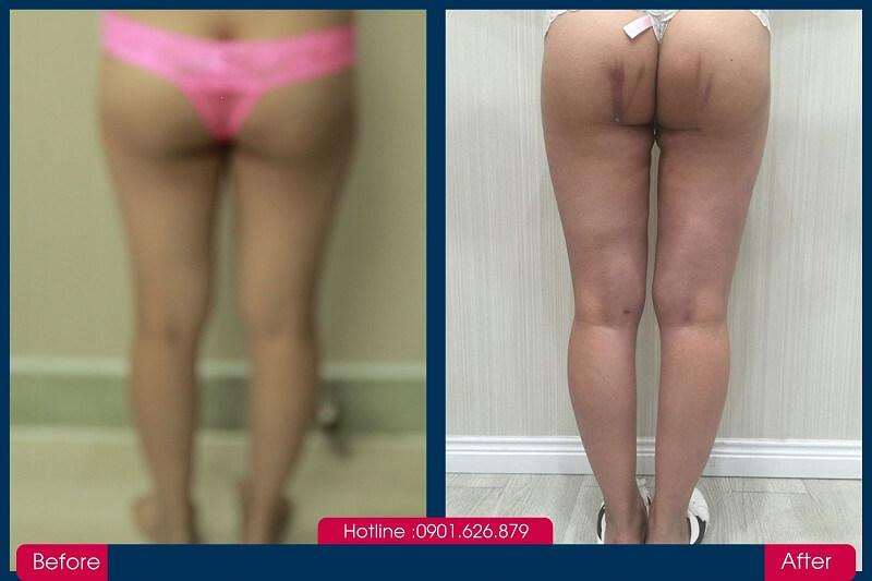 Hình ảnh trước và sau khi đánh tan mỡ bụng bằng Lipo Mìnat