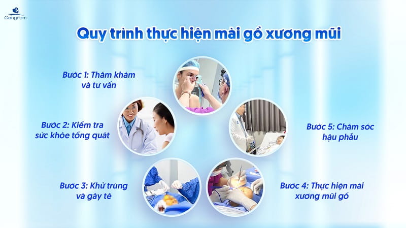 Mài gồ xương mũi - Giải pháp cho chiếc mũi cao thẳng, thanh tú 8 Mài gồ xương mũi