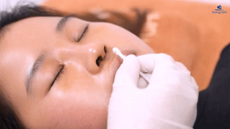 Nâng mũi siêu cao - Giải pháp kiến tạo vẻ đẹp "lai Tây" 9 Nâng mũi siêu cao