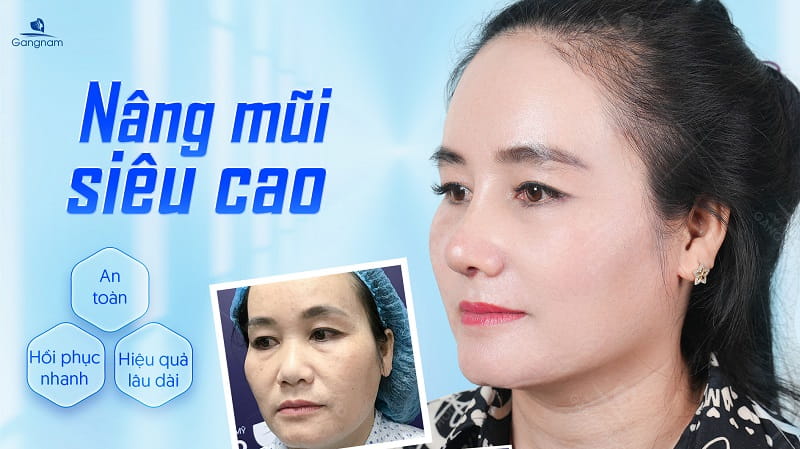 Nâng mũi siêu cao - Giải pháp kiến tạo vẻ đẹp "lai Tây" 8 Nâng mũi siêu cao