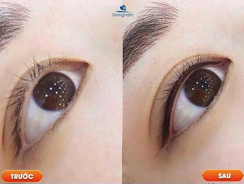 Phun mí mắt có bị già không? 8 Phun mí mở tròng