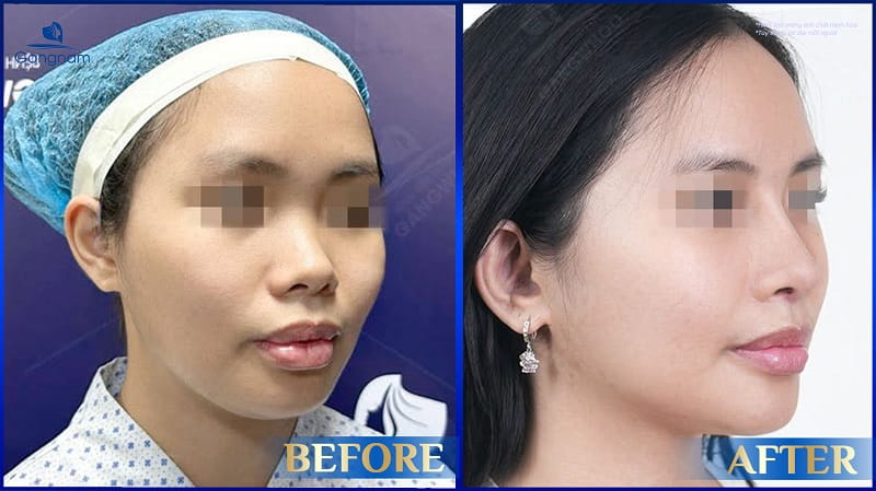 Dáng mũi hếch là gì? Có nên sửa mũi hếch không? 9 Mũi hếch là gì?