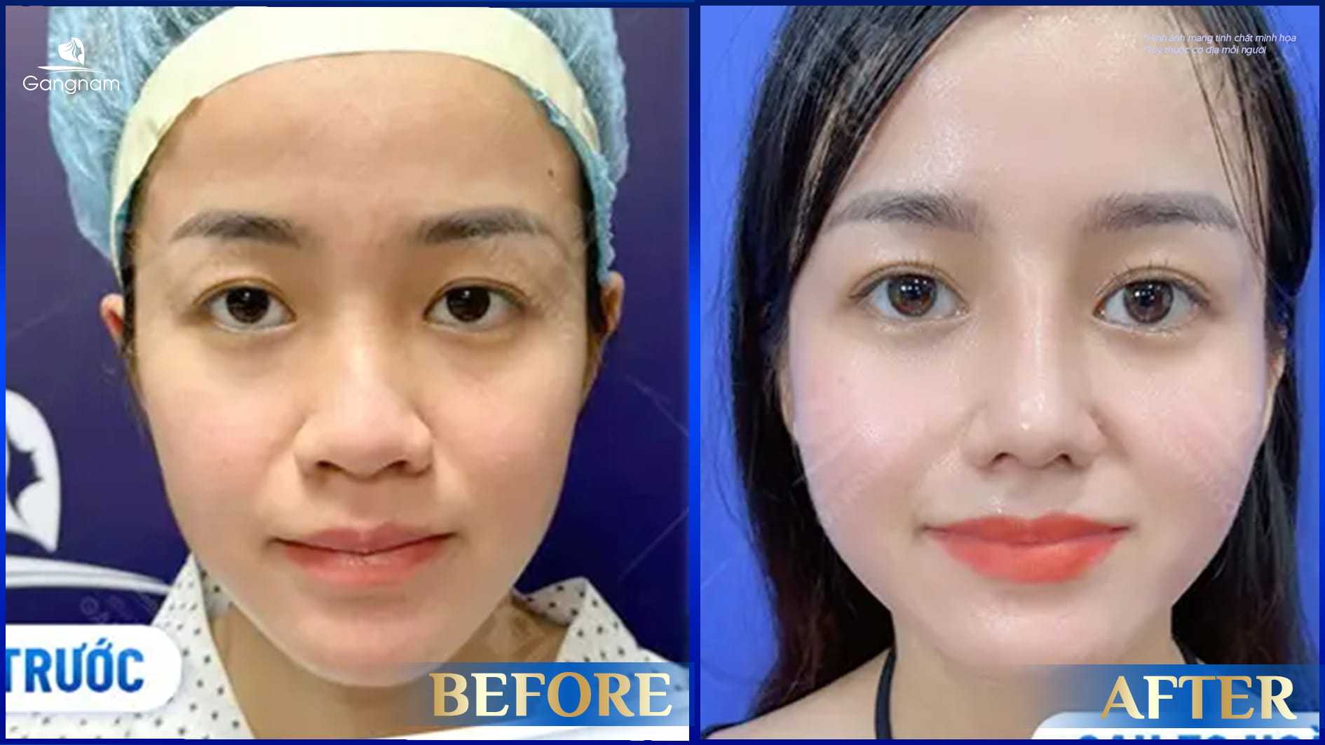 Mũi to là như thế nào? Tướng mũi to tốt hay xấu? 10 Mũi to là như thế nào?