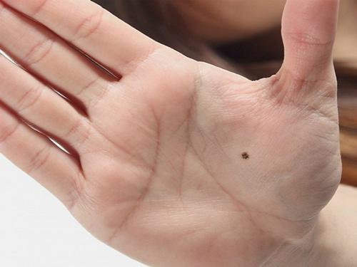 Nốt ruồi ở lòng bàn tay có ý nghĩa gì?