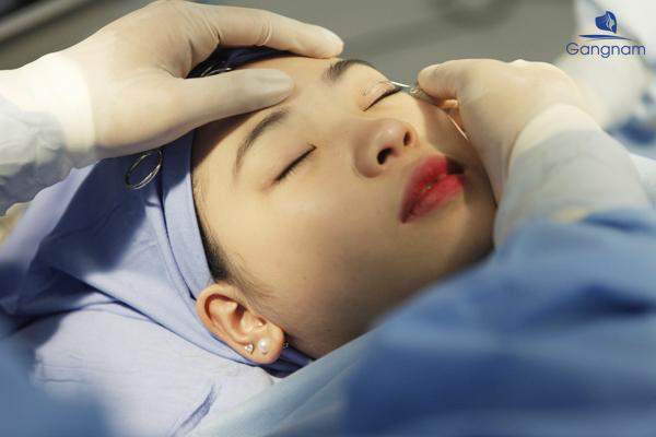 Quy trình cắt mí mắt chuẩn y khoa
