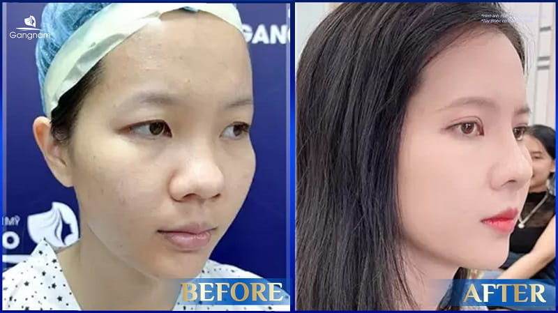 Nâng mũi trả góp là gì? Có nên nâng mũi trả góp không? 8 Cách chăm sóc sau nâng mũi cấu trúc