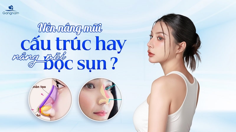 Nâng mũi cấu trúc hay bọc sụn