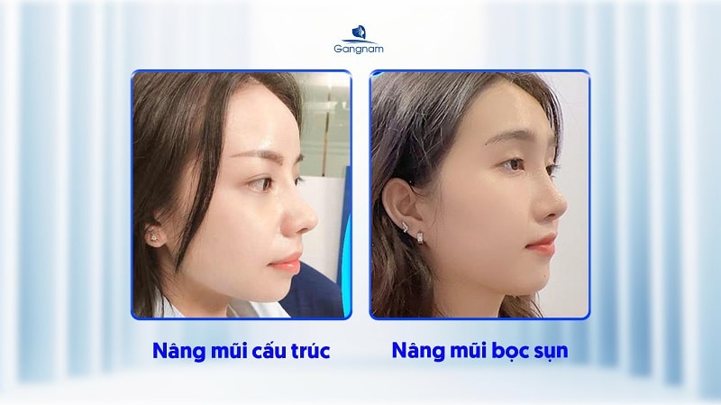 Nên nâng mũi cấu trúc hay bọc sụn? 6 Nâng mũi cấu trúc hay bọc sụn