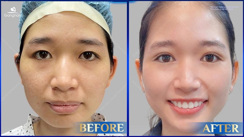 Cắt mí Hàn Quốc có vĩnh viễn không? 8 Cắt mí Hàn Quốc có vĩnh viễn không?