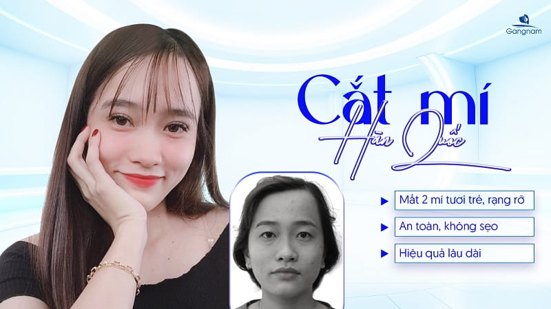 Cắt mí Hàn Quốc có vĩnh viễn không? 6 Cắt mí Hàn Quốc có vĩnh viễn không?