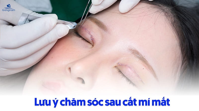 Cắt mí Hàn Quốc có vĩnh viễn không? 7 Cắt mí Hàn Quốc có vĩnh viễn không?