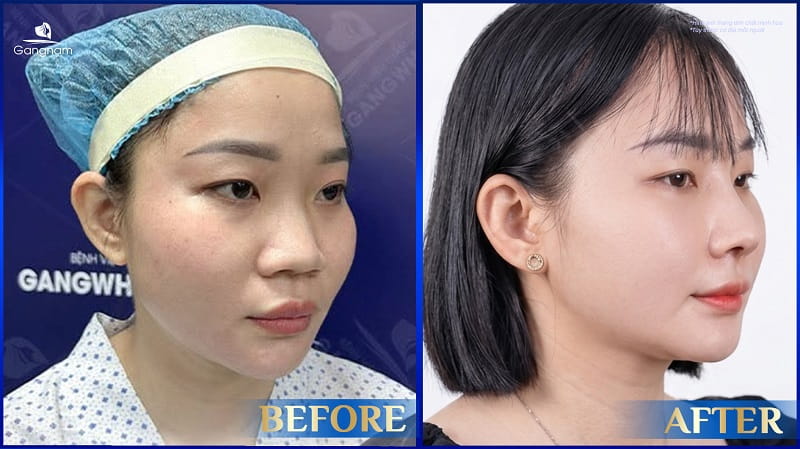 Nâng mũi bọc sụn ở đâu đẹp? Địa chỉ nâng mũi uy tín tại Tp Hồ Chí Minh 8 Nâng mũi bọc sụn ở đâu đẹp?