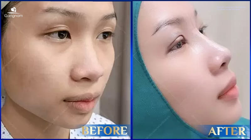 Quy trình nâng mũi Hàn Quốc đạt chuẩn diễn ra như thế nào? 8 Quy trình nâng mũi Hàn Quốc