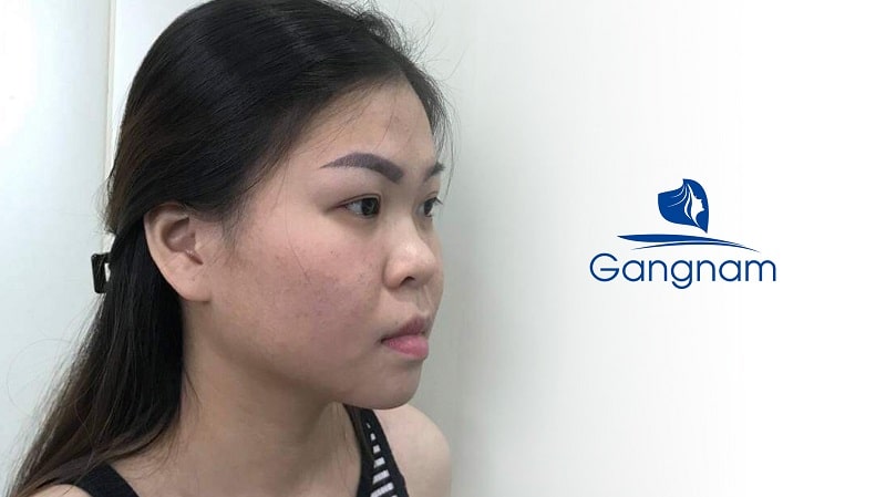 Trường hợp nào nên nâng mũi bọc sụn? 6 Trường hợp nào nên nâng mũi bọc sụn?