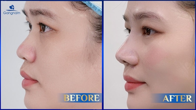 Trường hợp nào nên nâng mũi bọc sụn? 8 Trường hợp nào nên nâng mũi bọc sụn?