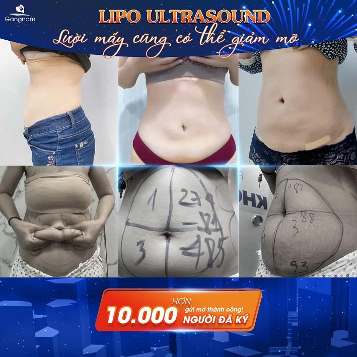 Công nghệ giảm béo mỡ bụng lipo ultrasound