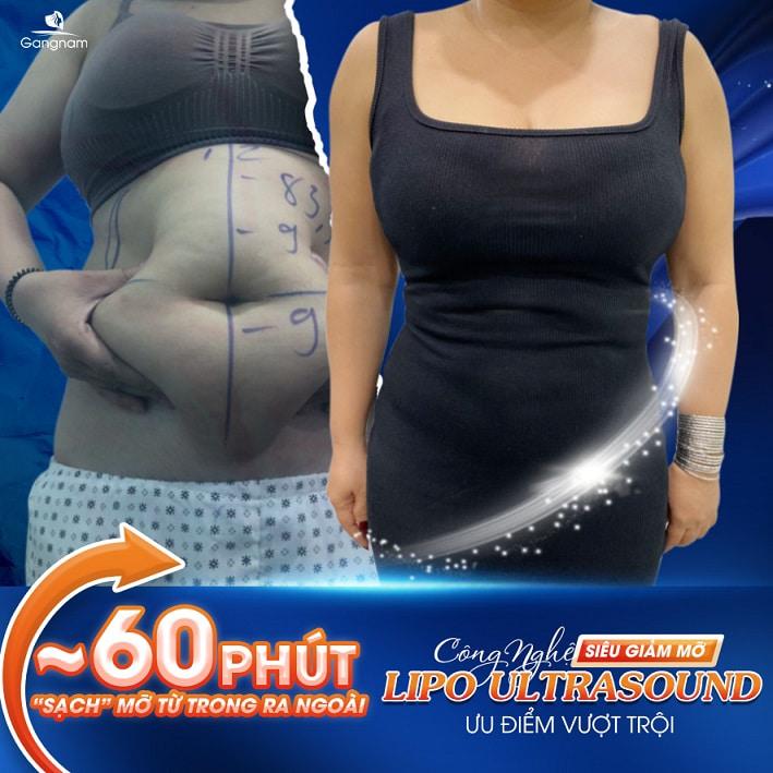 Công nghệ giảm béo tốt nhất hiện nay - lipo ultrasoud