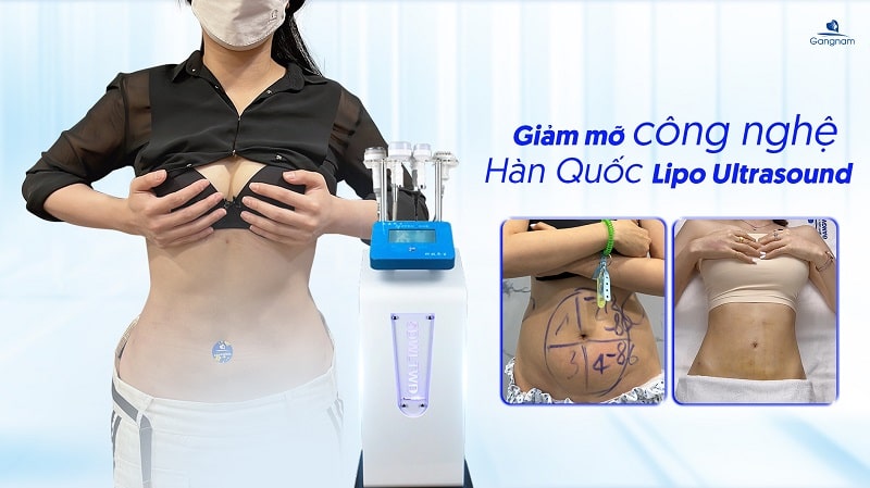 Công nghệ giảm béo tốt nhất hiện nay không cần phẫu thuật là gì ? #1 4 Giảm mỡ Lipo Ultrasound