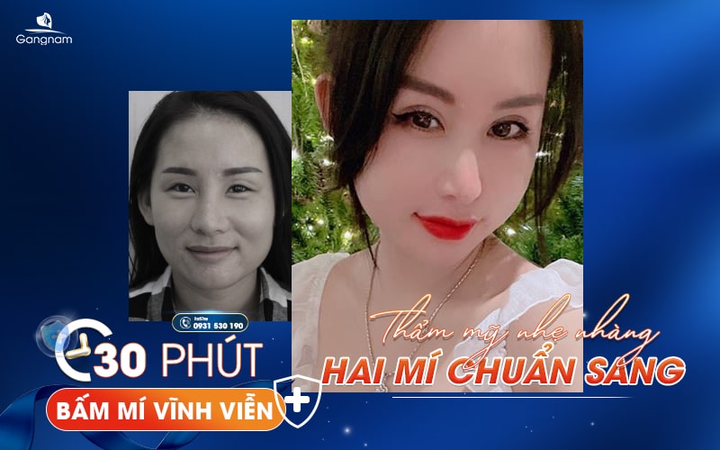 Bấm mí mắt là gì? Giữ được bao lâu? 11 Bấm mí mắt thẩm mỹ viện gangnam
