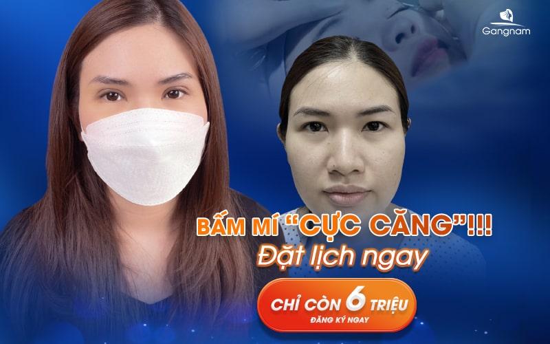 Bấm mí mắt là gì? Giữ được bao lâu? 10 bấm mí mắt là gì