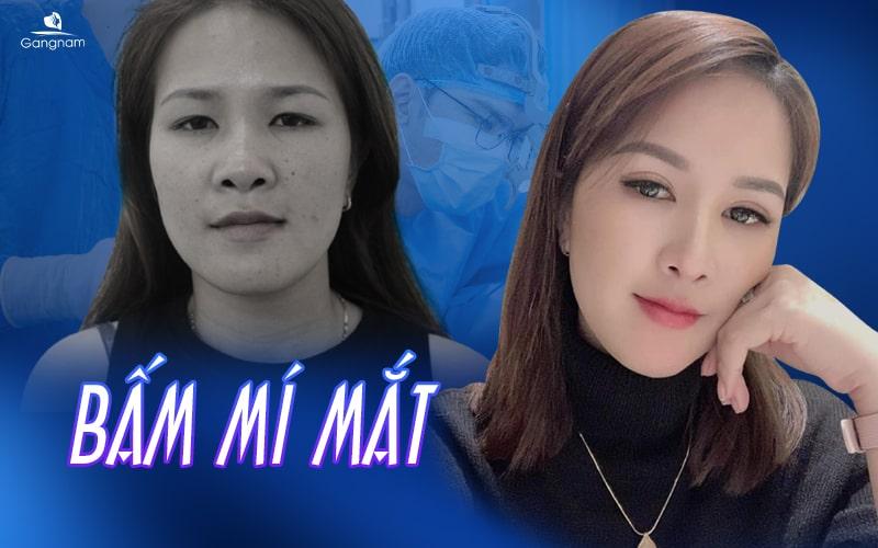 Bấm mí mắt là gì? Giữ được bao lâu? 9 bấm mí mắt là gì?