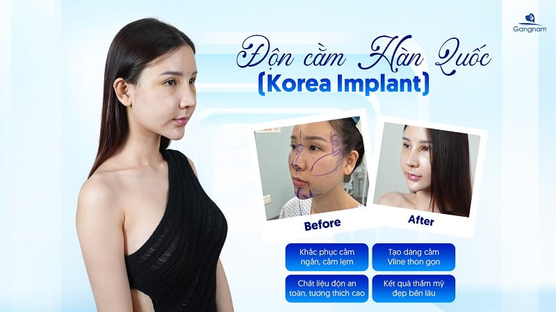 Độn cằm Korea Implant - Giải pháp kiến tạo gương mặt V-Line thanh thoát 8 Độn cằm Korea Implant