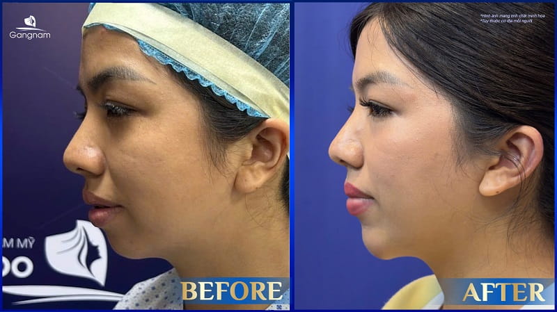 Độn cằm Korea Implant - Giải pháp kiến tạo gương mặt V-Line thanh thoát 10 Độn cằm Korea Implant
