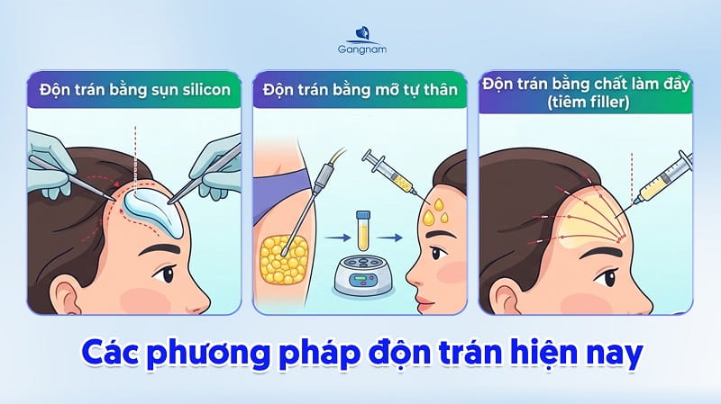 Độn trán là gì? Các phương pháp độn trán phổ biến hiện nay 7 Độn trán là gì?