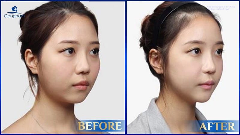 Độn trán là gì? Các phương pháp độn trán phổ biến hiện nay 9 Độn trán là gì?