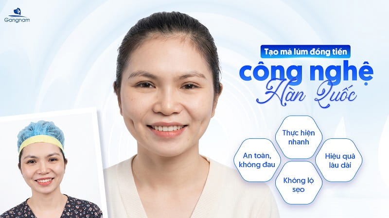 Tạo má lúm đồng tiền - Sở hữu nụ cười thu hút mọi ánh nhìn 7 Tạo má lúm đồng tiền