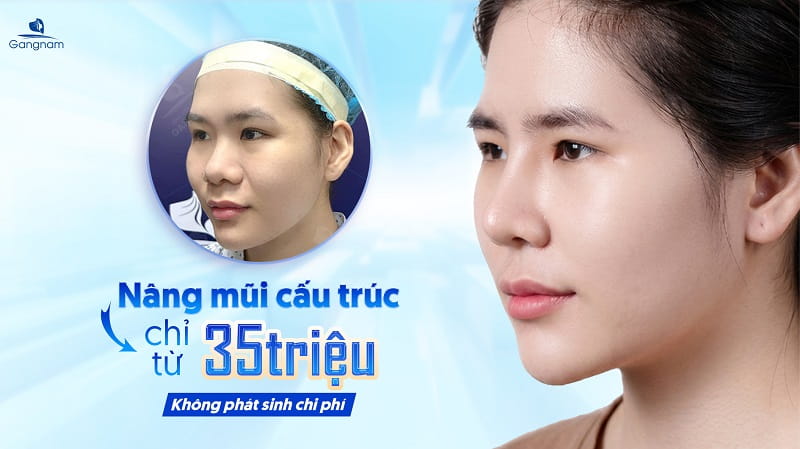 Nâng mũi giá bao nhiêu tiền? Cập nhật bảng giá 2026 7 Nâng mũi giá bao nhiêu tiền?