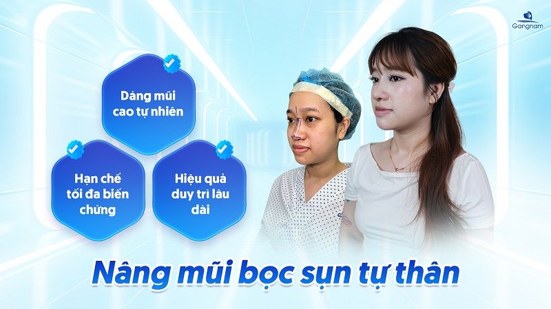 Nâng mũi sụn tự thân có tốt không? 8 Nâng mũi sụn tự thân