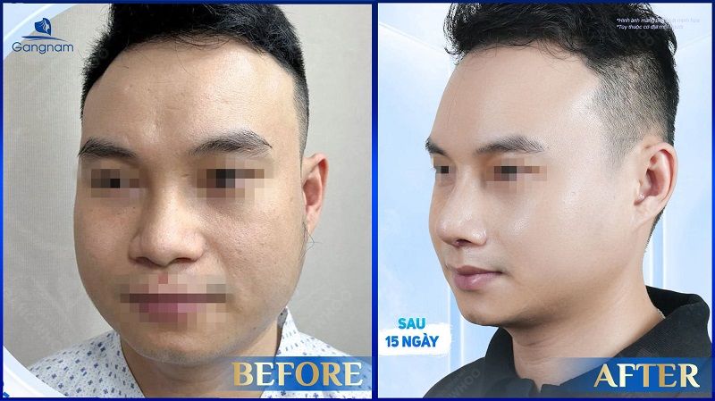 Nâng mũi L-line cho nam - Sở hữu nét đẹp "chuẩn men" chỉ sau 60 phút 11 Nâng mũi L-line cho nam