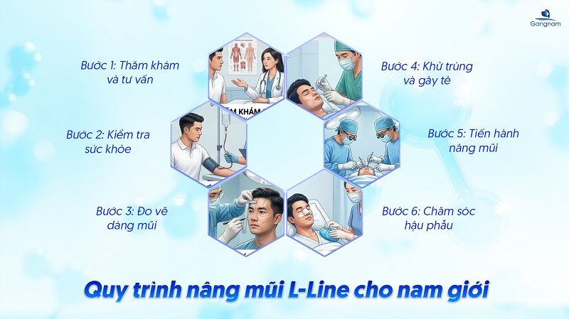 Nâng mũi L-line cho nam - Sở hữu nét đẹp "chuẩn men" chỉ sau 60 phút 10 Nâng mũi L-line cho nam