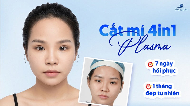 Cắt mí bao lâu thì đẹp tự nhiên? 3 giai đoạn hồi phục sau cắt mí mắt 7 Cắt mí bao lâu thì đẹp tự nhiên?