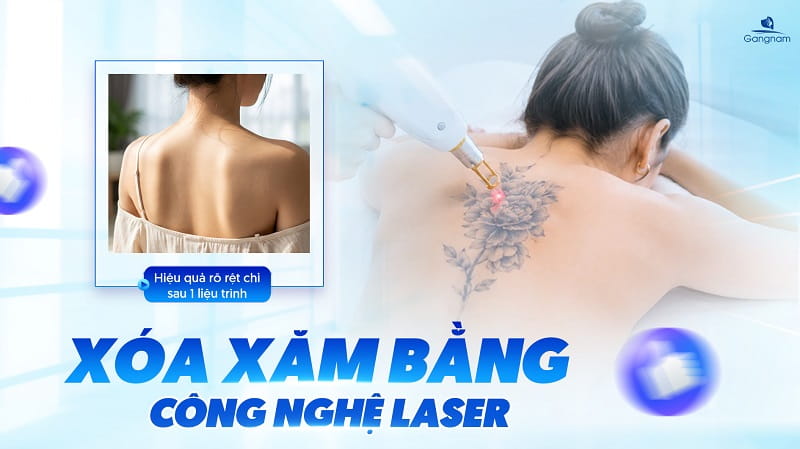 Xóa xăm bằng công nghệ Laser - Hiệu quả rõ rệt chỉ sau 1 liệu trình 7 Xóa xăm bằng công nghệ Laser