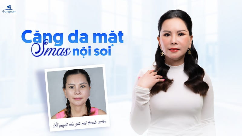 Căng da mặt Smas - Vực dậy thanh xuân chỉ 60 phút 7 Căng da mặt Smas