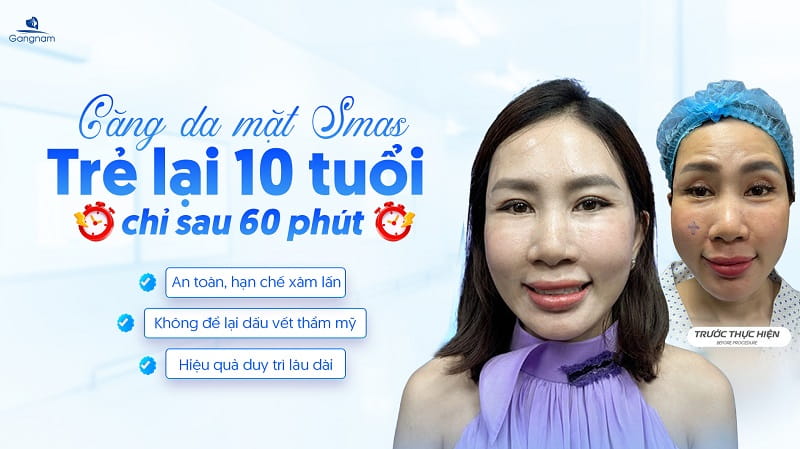 Căng da mặt Smas - Vực dậy thanh xuân chỉ 60 phút 8 Căng da mặt Smas