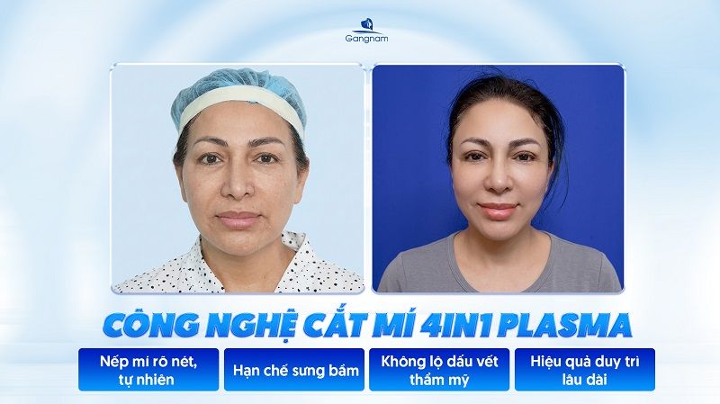 cắt mí 4 in 1 Plasma - Giải pháp trẻ hóa đôi mắt toàn diện 6 Cắt mí 4 In 1