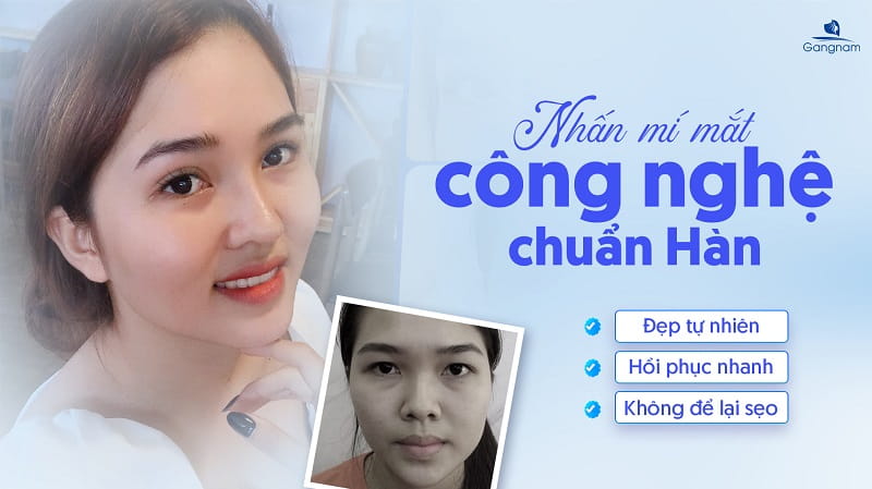 Nhấn mí mắt là gì? Tìm hiểu 3 phương pháp nhấn mí phổ biến hiện nay 9 Nhấn mí mắt là gì?