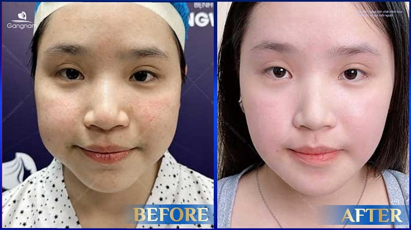 Gọt hàm đeo đai định hình bao lâu? 9 Phẫu thuật gọt hàm